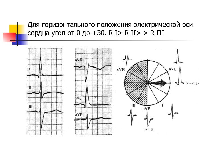 Для горизонтального положения электрической оси сердца угол от 0 до +30. R