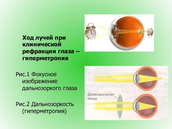 Ход лучей при клинической рефракции глаза – гиперметропия Рис.1