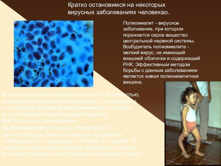 Полиомиелит - вирусное заболевание, при котором поражается серое вещество центральной нервной