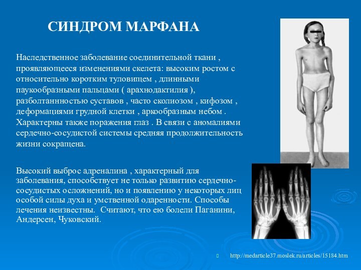 http://medarticle37.moslek.ru/articles/15184.htm Наследственное заболевание соединительной ткани , проявляющееся изменениями скелета: высоким ростом