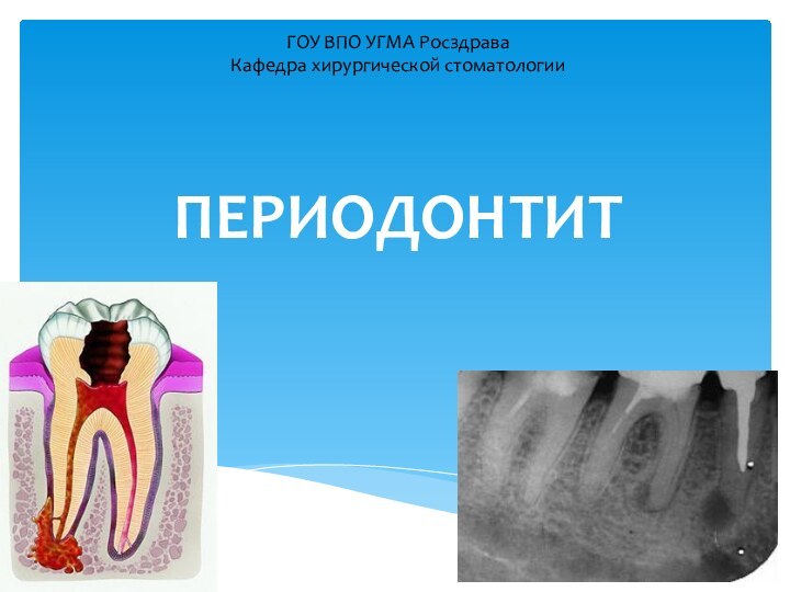 ПЕРИОДОНТИТГОУ ВПО УГМА РосздраваКафедра хирургической стоматологии
