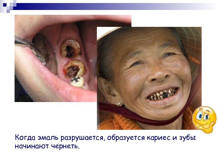 Когда эмаль разрушается, образуется кариес и зубы начинают чернеть.