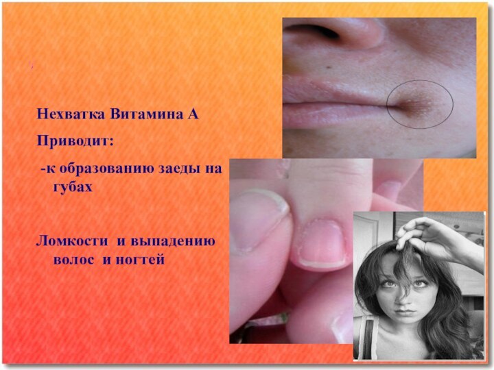 Нехватка Витамина АПриводит: -к образованию заеды на губахЛомкости и выпадению волос и ногтей
