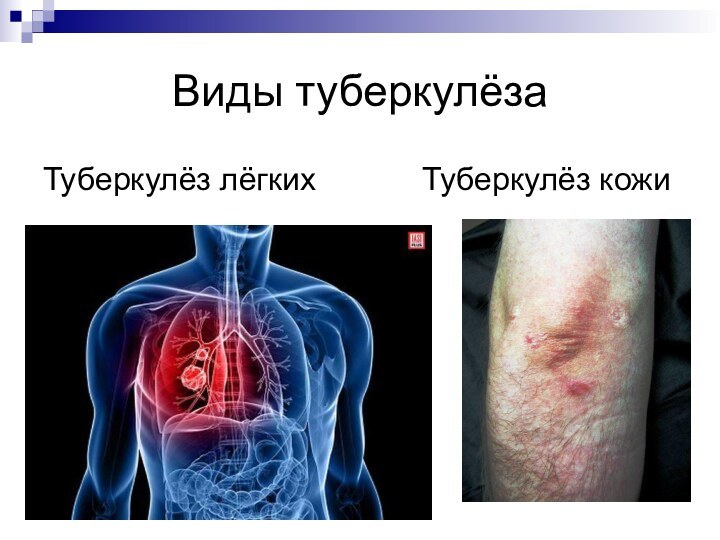 Виды туберкулёзаТуберкулёз лёгких      Туберкулёз кожи