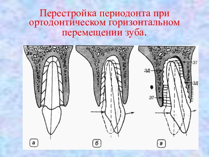 Перестройка периодонта при ортодонтическом горизонтальном перемещении зуба.
