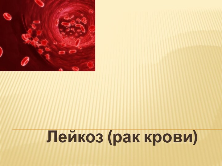  Лейкоз (рак крови)