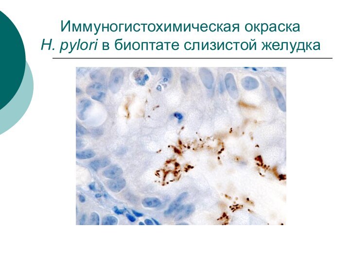 Иммуногистохимическая окраска  H. pylori в биоптате слизистой желудка
