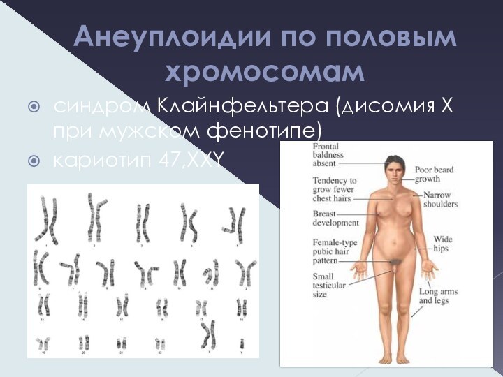 Анеуплоидии по половым хромосомамсиндром Клайнфельтера (дисомия Х при мужском фенотипе)кариотип 47,XXY