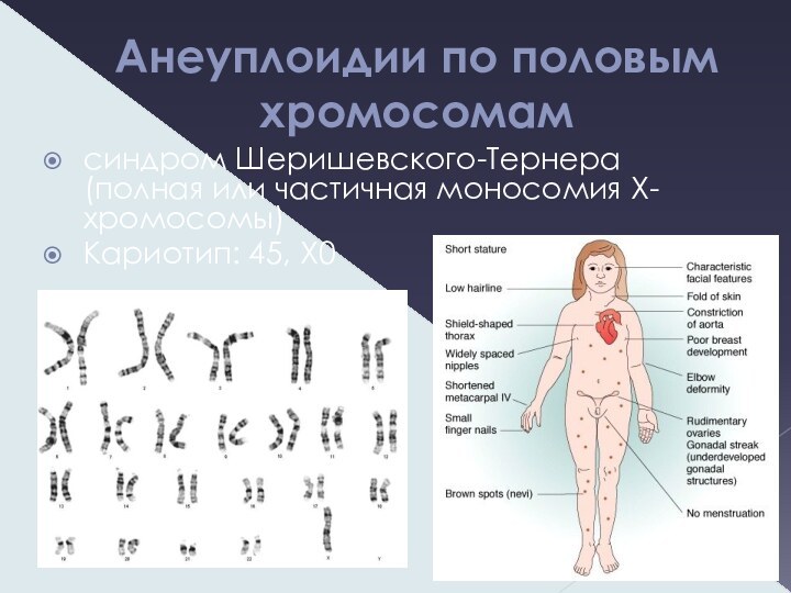 Анеуплоидии по половым хромосомамсиндром Шеришевского-Тернера (полная или частичная моносомия X-хромосомы)Кариотип: 45, X0