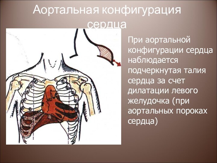 Аортальная конфигурация сердцаПри аортальной конфигурации сердца наблюдается подчеркнутая талия сердца за счет