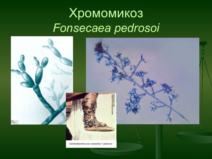 Хромомикоз  Fonsecaea pedrosoi