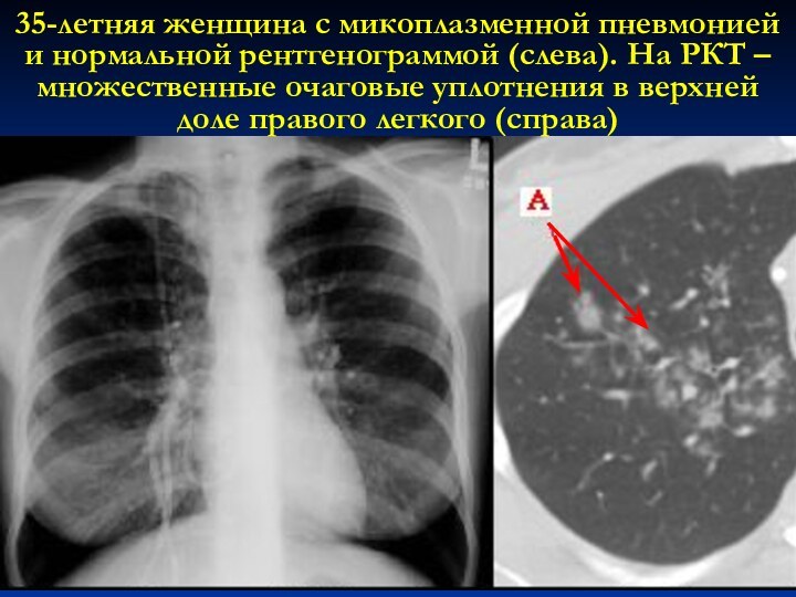 35-летняя женщина с микоплазменной пневмонией и нормальной рентгенограммой (слева). На РКТ –