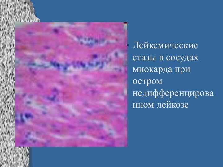 Лейкемические стазы в сосудах миокарда при остром недифференцированном лейкозе