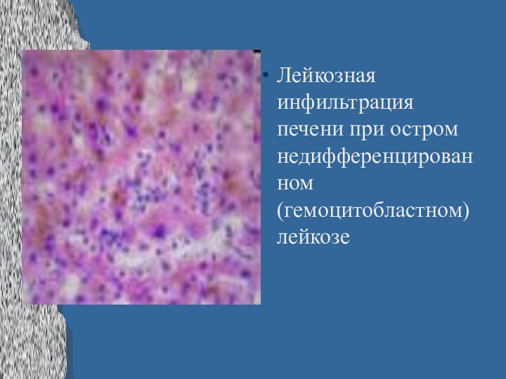 Лейкозная инфильтрация печени при остром недифференцированном (гемоцитобластном) лейкозе
