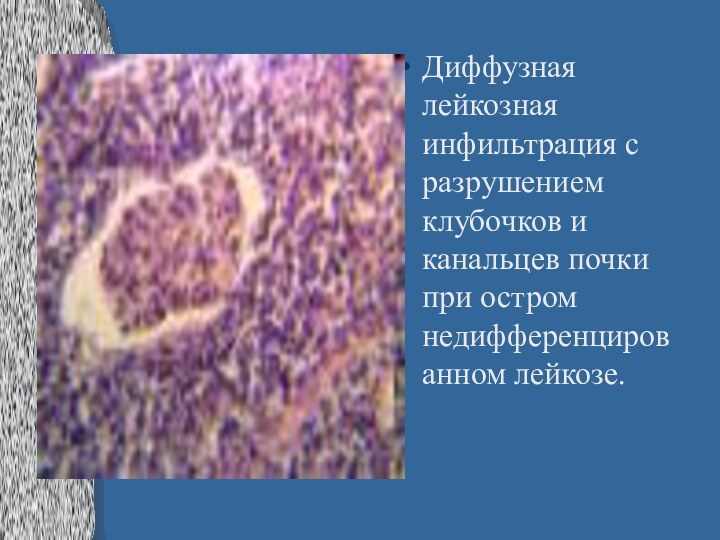 Диффузная лейкозная инфильтрация с разрушением клубочков и канальцев почки при остром недифференцированном лейкозе.