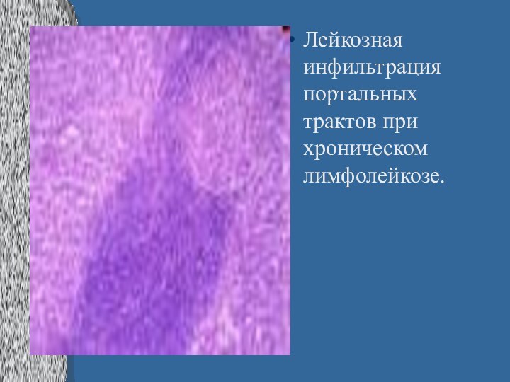 Лейкозная инфильтрация портальных трактов при хроническом лимфолейкозе.