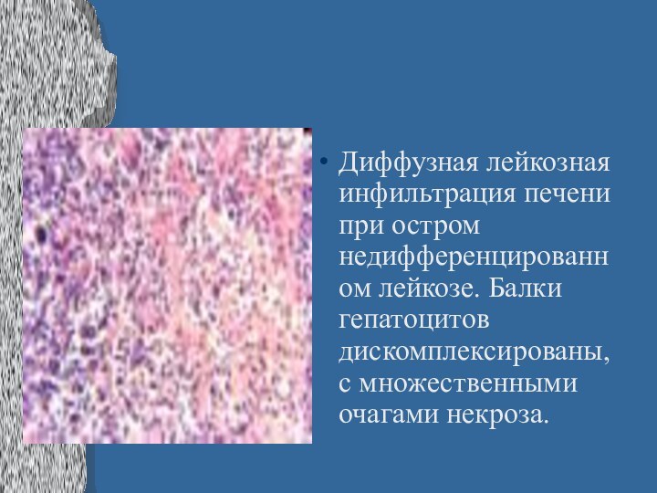 Диффузная лейкозная инфильтрация печени при остром недифференцированном лейкозе. Балки гепатоцитов дискомплексированы, с множественными очагами некроза.