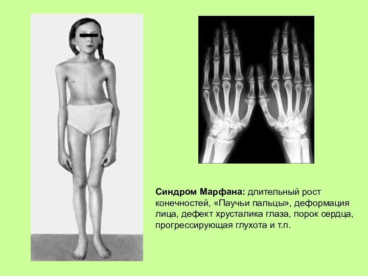Синдром Марфана: длительный ростконечностей, «Паучьи пальцы», деформациялица, дефект хрусталика глаза, порок сердца, прогрессирующая глухота и т.п.