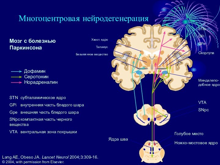 Многоцентровая нейродегенерацияLang AE, Obeso JA. Lancet Neurol 2004;3:309-16.  © 2004, with permission from Elsevier.