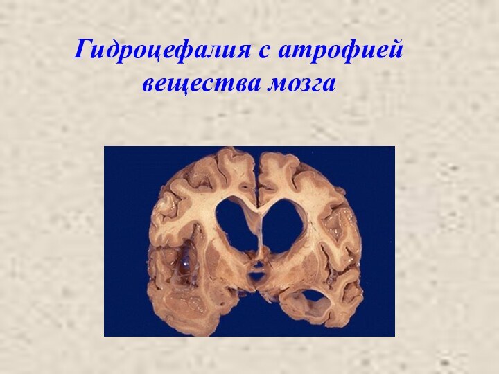Гидроцефалия с атрофией вещества мозга