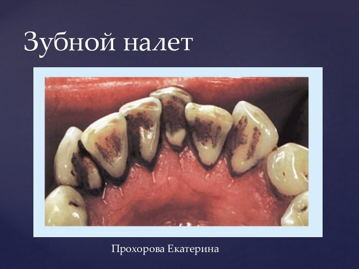 Зубной налетПрохорова Екатерина