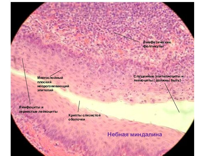 Небная миндалинаЛимфатические фолликулыМногослойный плоский неороговевающий эпителийКрипты слизистой оболочкиЛимфоциты и зернистые лейкоцитыСлущенные эпителиоциты
