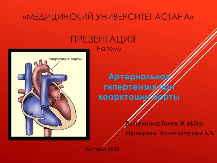«Медицинский Университет Астана» Артериальная гипертензия при   коарктации аортыПРЕЗЕНТАЦИЯ