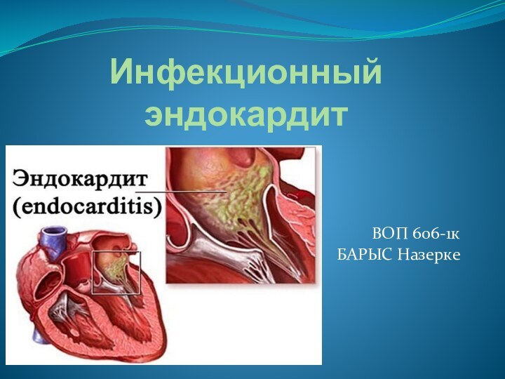 Инфекционный эндокардит  ВОП 606-1кБАРЫС Назерке