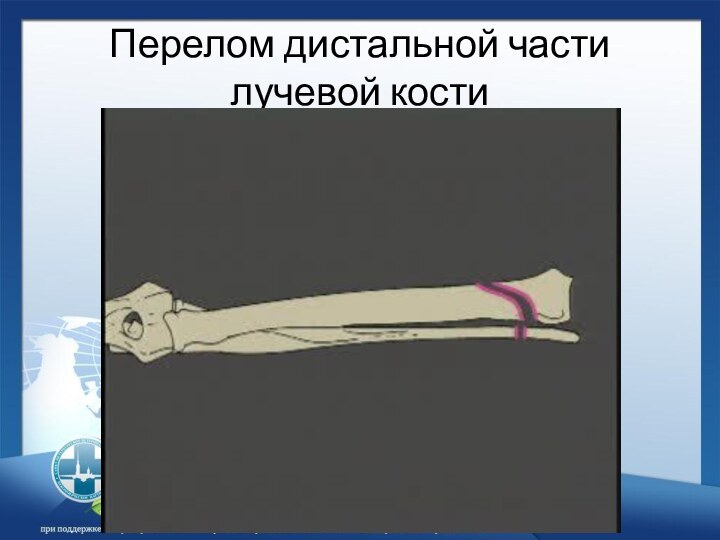 Перелом дистальной части лучевой кости