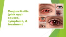 Conjunctivitis(pink eye) causes,  symptoms, & treatment