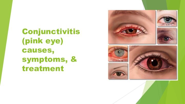 Conjunctivitis (pink eye) causes, symptoms, & treatment