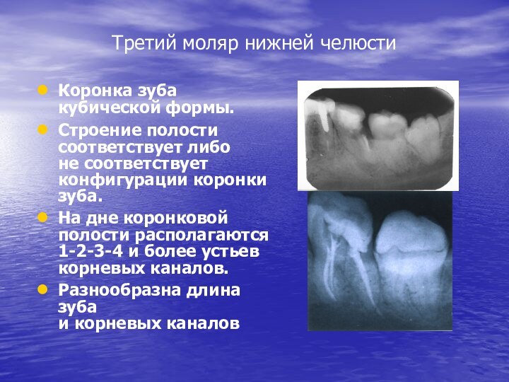 Третий моляр нижней челюстиКоронка зуба кубической формы. Строение полости соответствует либо
