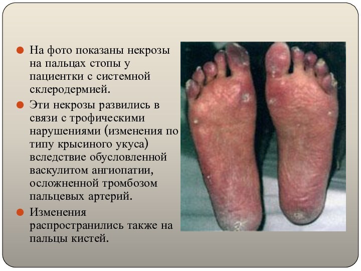 На фото показаны некрозы на пальцах стопы у пациентки с системной склеродермией.Эти