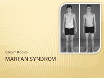 Marfansyndrom
