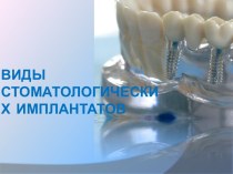 Виды стоматологических имплантатов