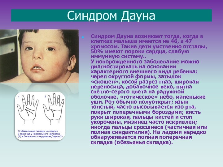 Синдром ДаунаСиндром Дауна возникает тогда, когда в клетках малыша имеется не 46,
