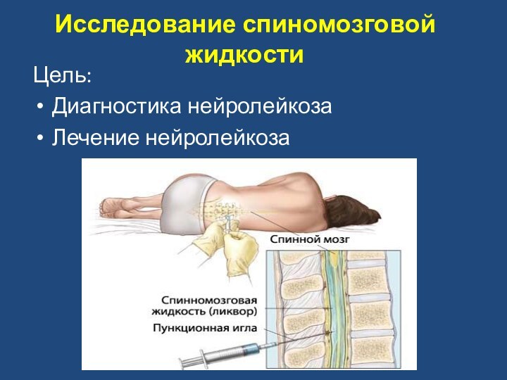 Цель:Диагностика нейролейкозаЛечение нейролейкозаИсследование спиномозговой жидкости