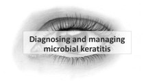 Diagnosing and managing microbial keratitis