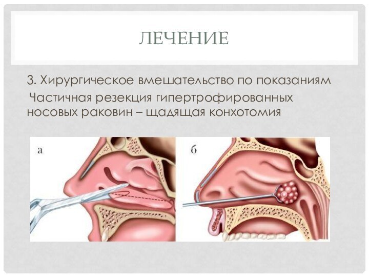 лечение3. Хирургическое вмешательство по показаниям Частичная резекция гипертрофированных носовых раковин – щадящая конхотомия