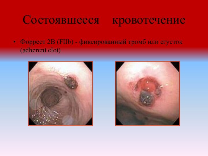 Состоявшееся  кровотечение Форрест 2В (FIIb) - фиксированный тромб или сгусток (adherent clot)