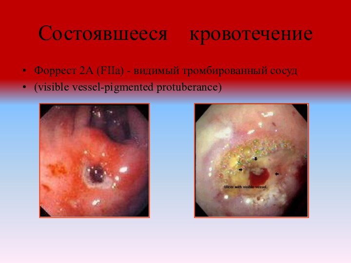 Состоявшееся  кровотечение Форрест 2А (FIIa) - видимый тромбированный сосуд(visible vessel-pigmented protuberance)