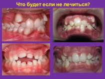 Зачем носить стоматологические пластинки