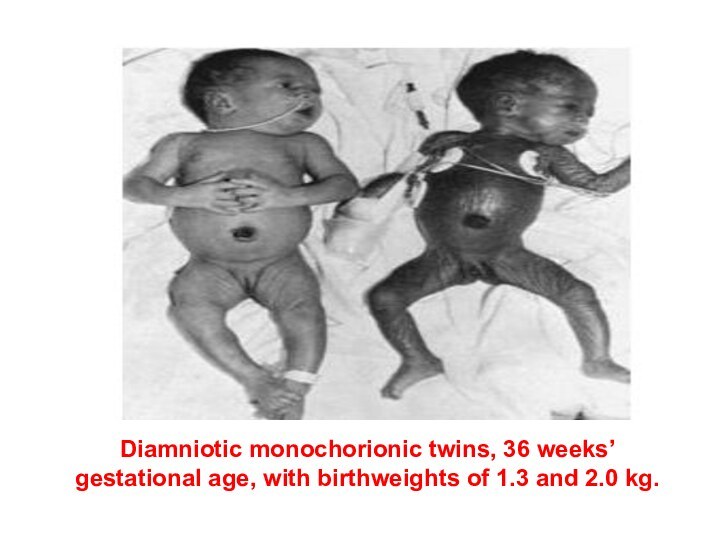 Diamniotic monochorionic twins, 36 weeks’gestational age, with birthweights of 1.3 and 2.0 kg.