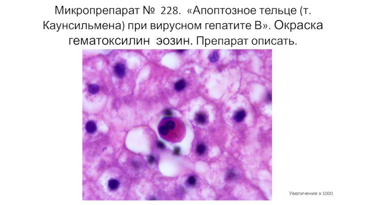 Микропрепарат № 228. «Апоптозное тельце (т. Каунсильмена) при вирусном гепатите В». Окраска