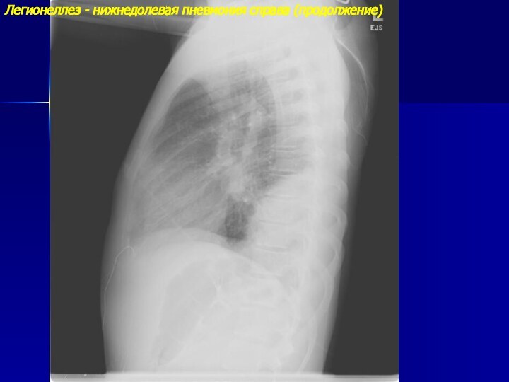 Легионеллез - нижнедолевая пневмония справа (продолжение)