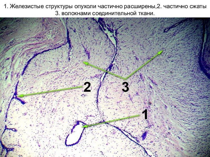 1. Железистые структуры опухоли частично расширены,2. частично сжаты 3. волокнами соединительной ткани.