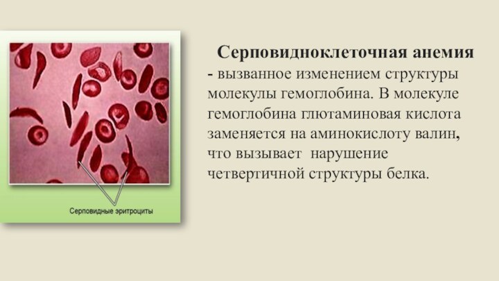 Серповидноклеточная анемия - вызванное изменением структуры молекулы гемоглобина. В молекуле гемоглобина глютаминовая