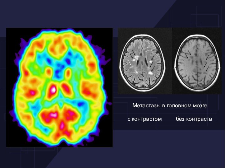 Метастазы в головном мозге с контрастом     без контраста