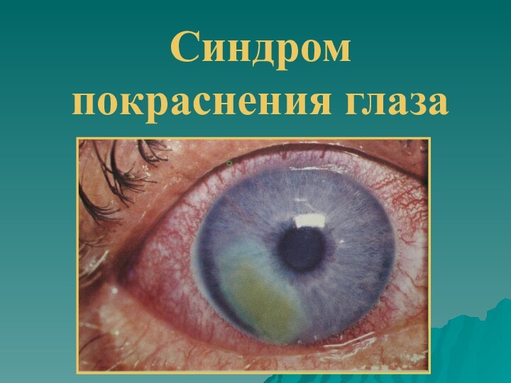 Синдром  покраснения глаза