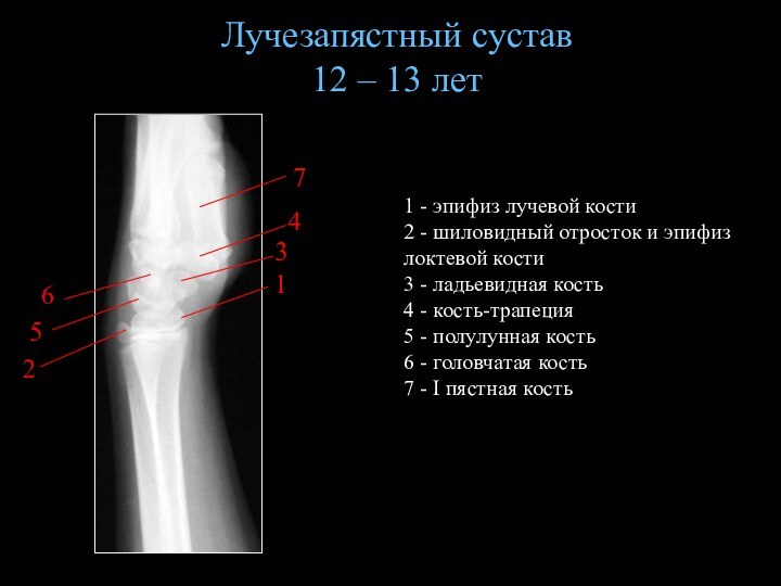 Лучезапястный сустав 12 – 13 лет1 - эпифиз лучевой кости2 - шиловидный